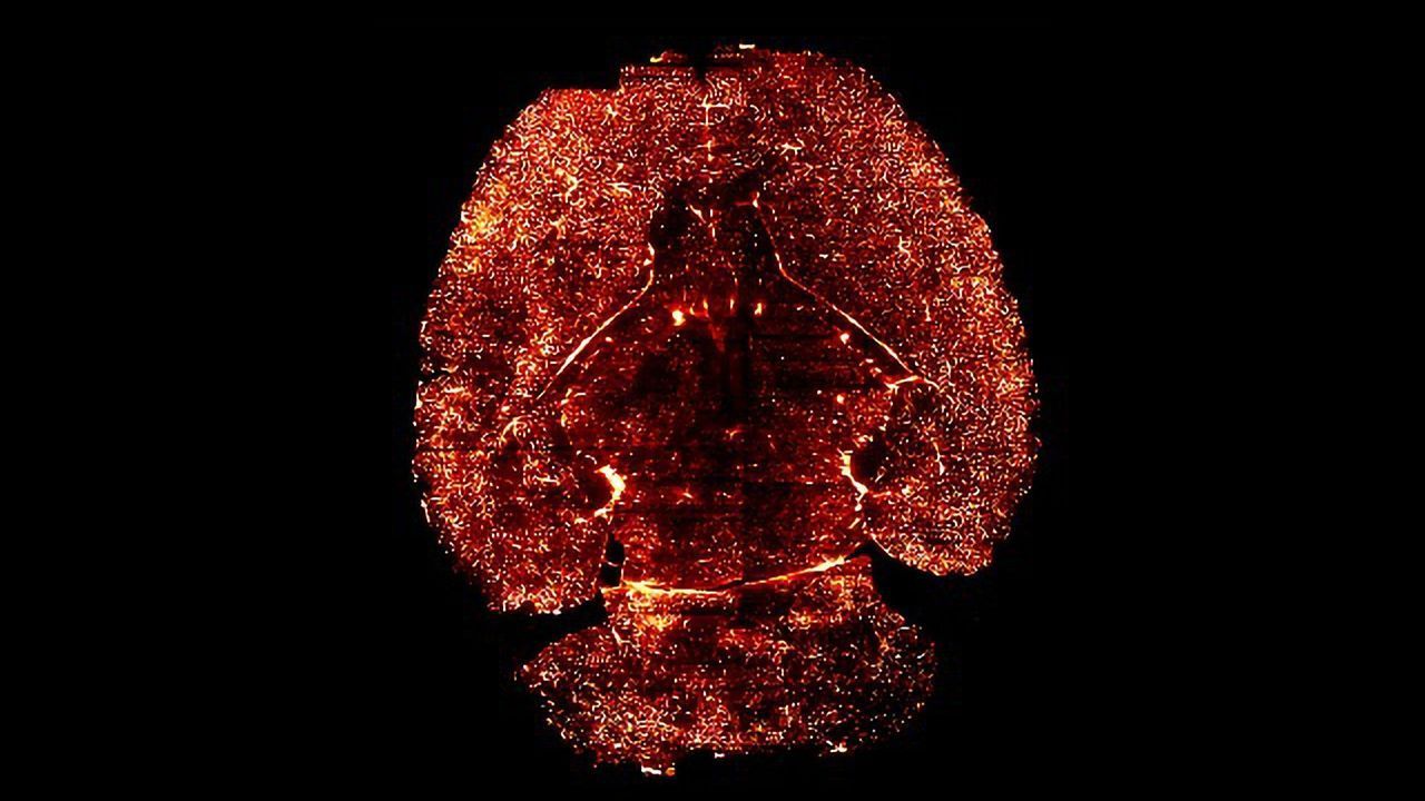 Blood-clotting Protein Destroys Synapses and Causes Cognitive Decline in Alzheimer's Model