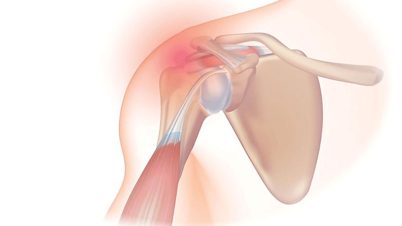 Lipid Deposition in Rotator Cuff Injuries