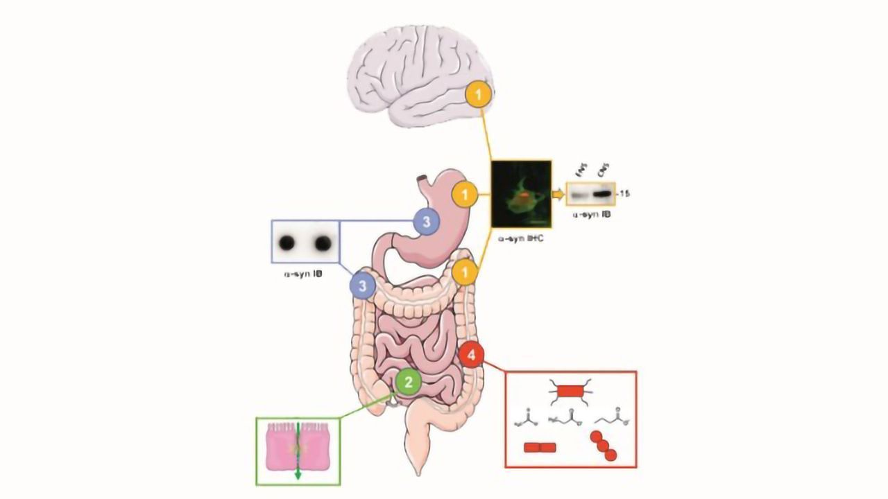 The Gut's Influence in Parkinson's Disease: Hype or Hope?