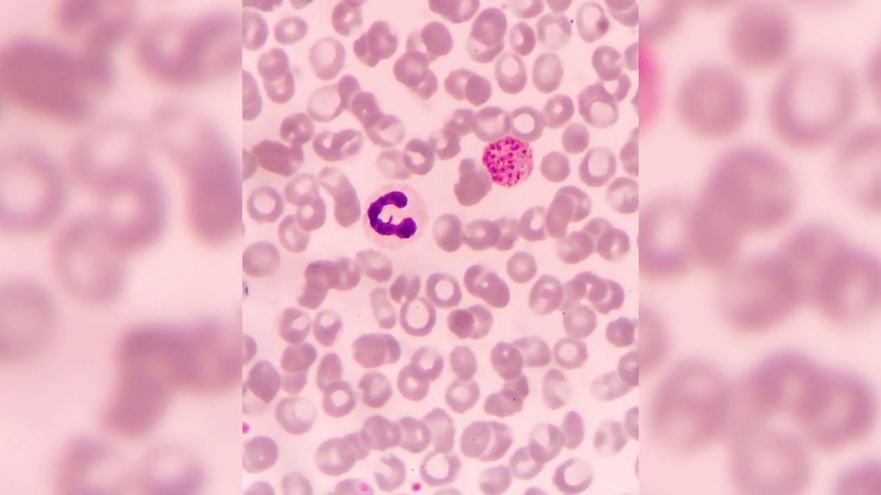 Parasite mRNA Analysis Reveals Complexity of Malaria Spread