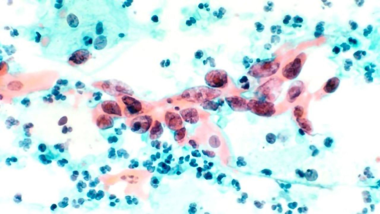 Trojan Horse Drug Kills Cancer Cells from Within