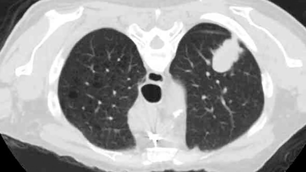 Mobile Lung Cancer Scanning to Be Rolled Out Across England
