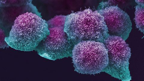Pancreatic Cancer-associated Fibroblast Subtyping Identifies New Targets
