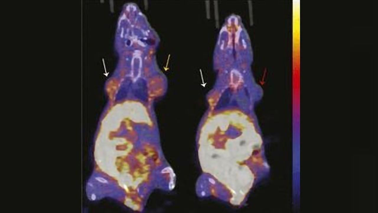 Imaging Agent Could Help Measure Effectiveness of Breast Cancer Therapy Earlier