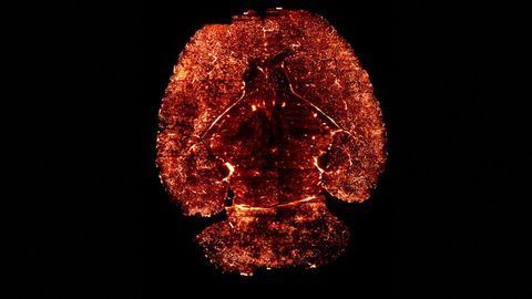 Alzheimer's and Neutrophil Adhesion in Brain Capillaries