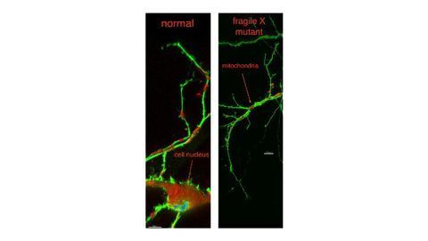Mitochondrial Dysfunction May Play a Part in Fragile X Syndrome