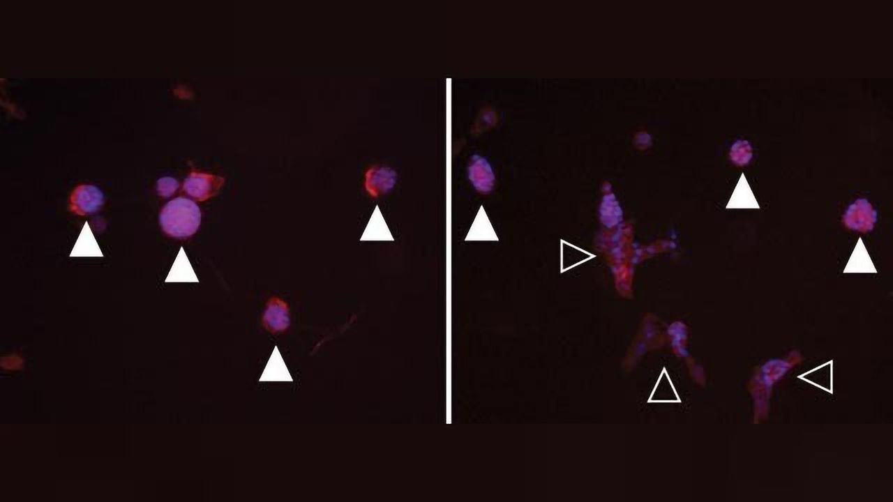 Breast Tissue Stiffening Linked to Breast Cancer Development
