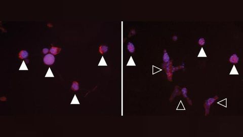 Breast Tissue Stiffening Linked to Breast Cancer Development