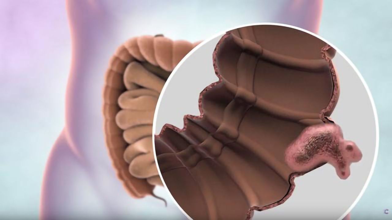 What is Bowel Cancer?