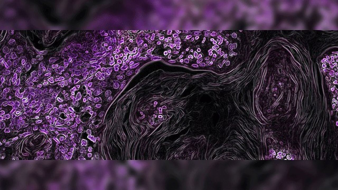 Micro-CT Captures Lung Cancer Biomarkers