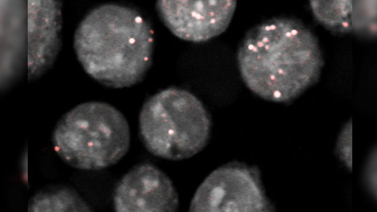 Rare Tumor Cell Type Unable to Synthesize Cholesterol