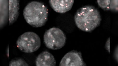 Rare Tumor Cell Type Unable to Synthesize Cholesterol