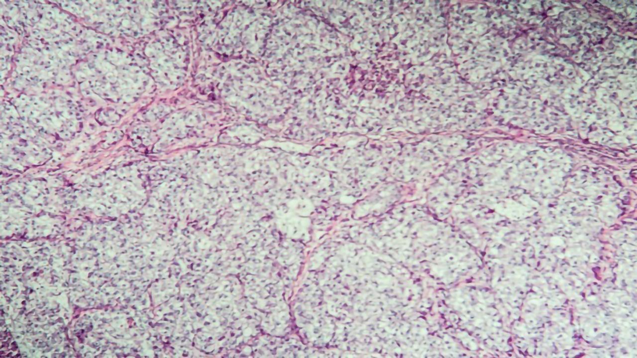 AI Predicts Survival of Ovarian Cancer Patients