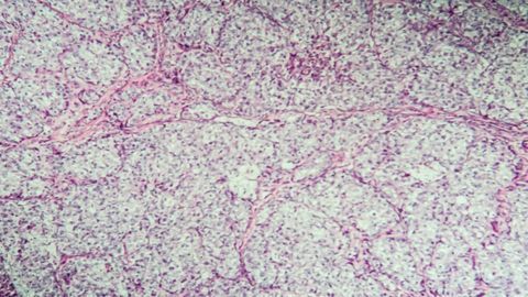 AI Predicts Survival of Ovarian Cancer Patients