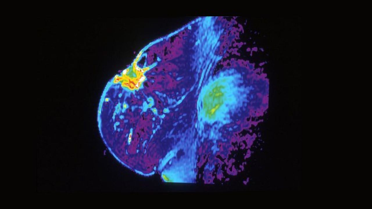 New Machine Learning Method Could Prevent Unnecessary Breast Surgery