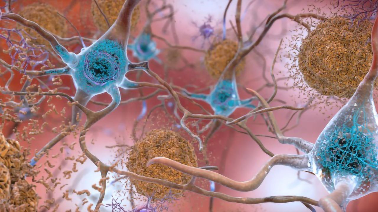 75,000-molecule Screen Reveals Amyloid-reducing Compound