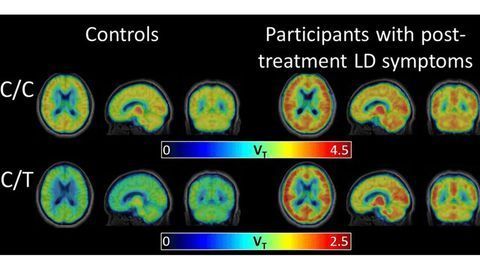 Widespread Brain Inflammation Revealed in Post-treatment Lyme Disease