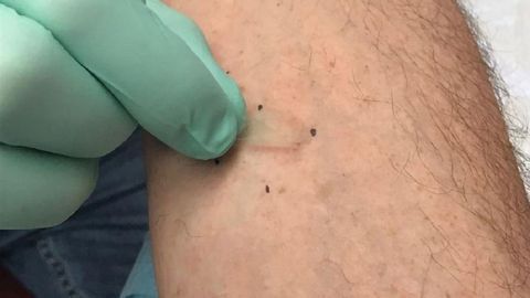 Unique Subtype of Eczema Linked to Food Allergy