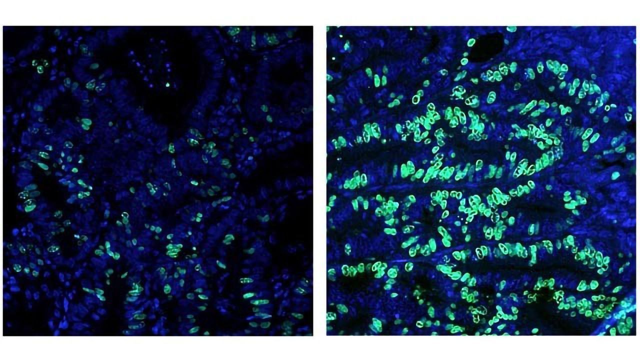 How Do High-fat Diets Fuel Colorectal Cancer Growth?