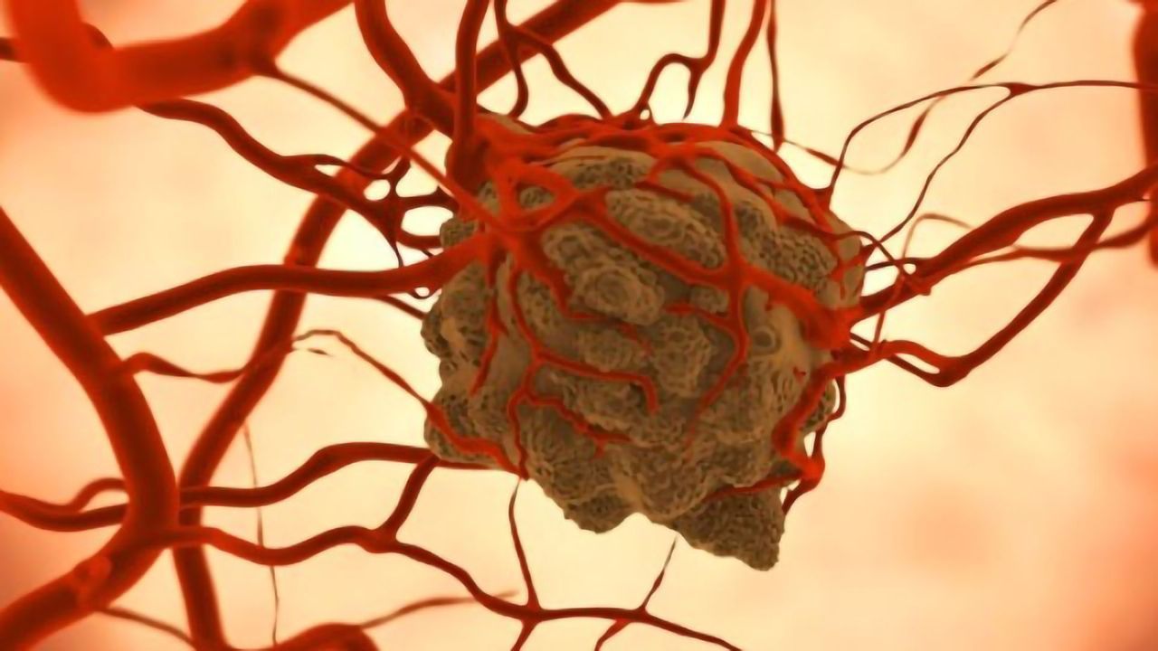 Antibody Therapy That Trains Phagocytes to Destroy Tumors Is Tested in Patients
