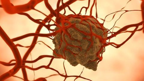 Antibody Therapy That Trains Phagocytes to Destroy Tumors Is Tested in Patients