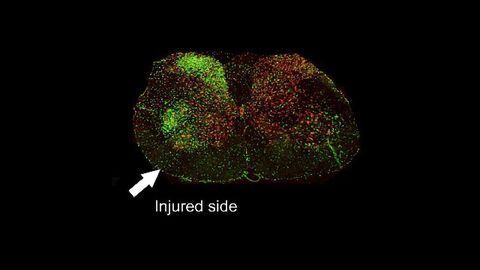 Can a Nerve Injury Trigger ALS?