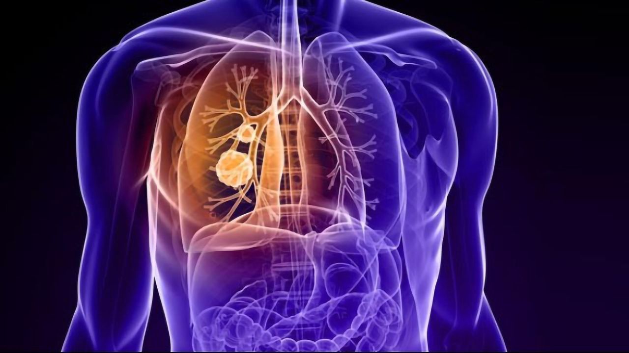 Taking a "BiTE" Out of Lung Cancer
