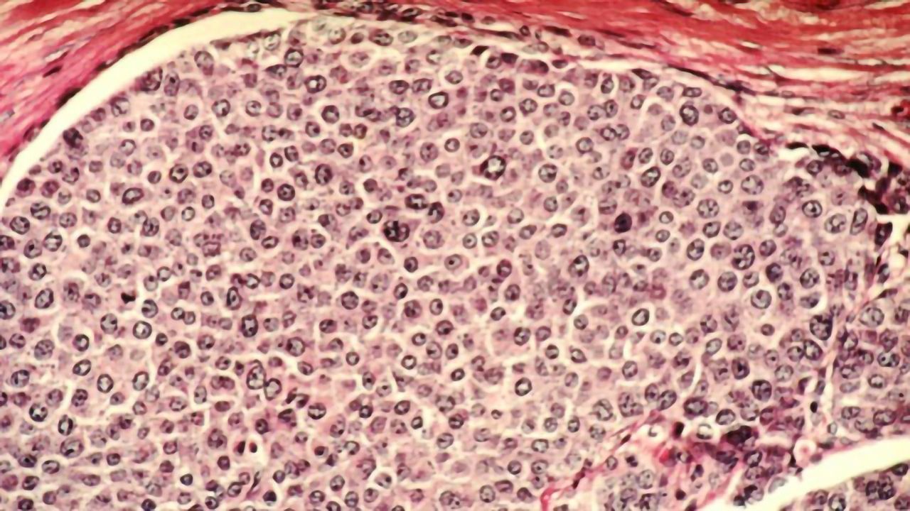 Devising a Potential Attack Strategy for Aggressive Breast Cancer