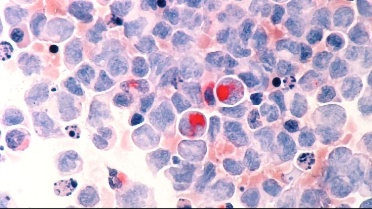Building an Atlas of Acute Myeloid Leukemia