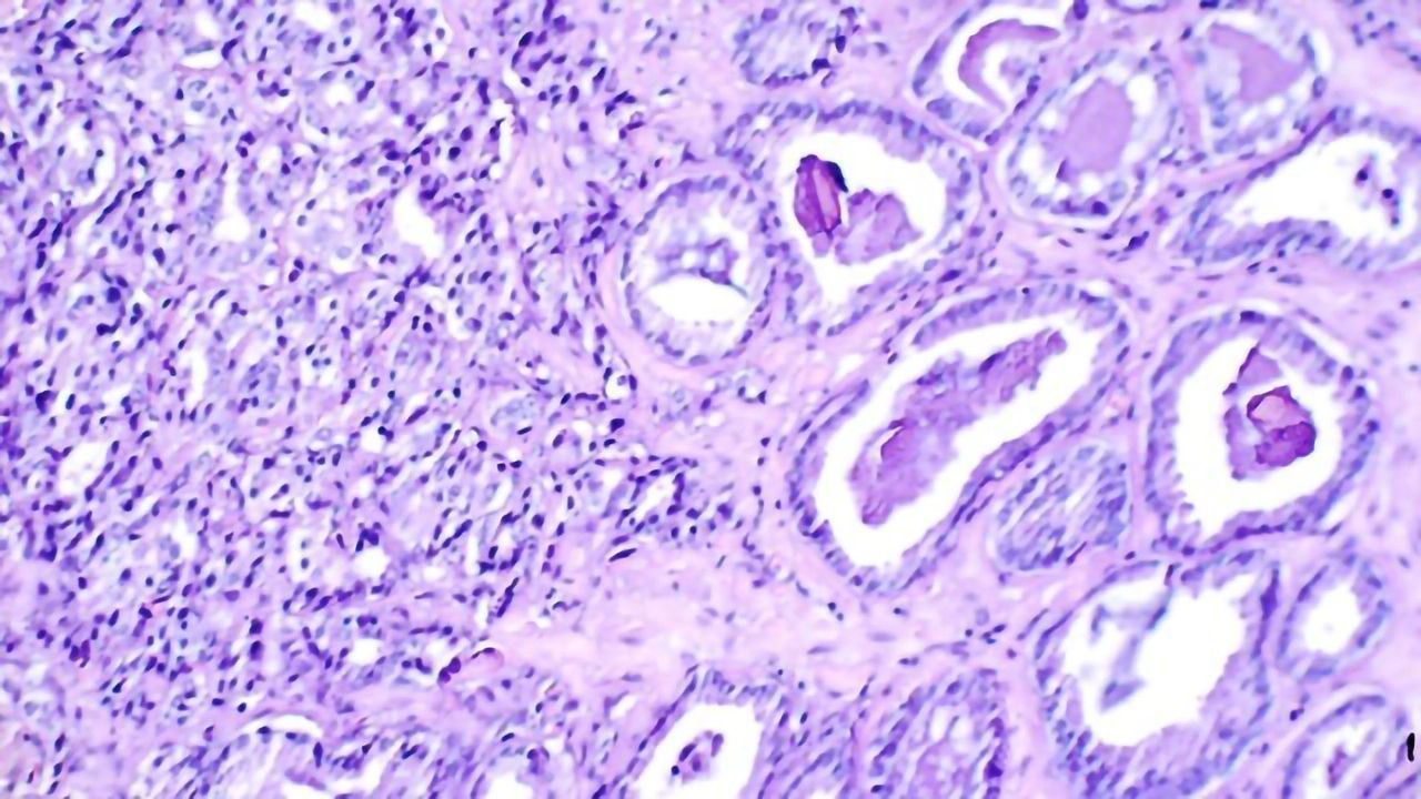 How Prostate Cancer Becomes Treatment Resistant