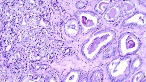 How Prostate Cancer Becomes Treatment Resistant