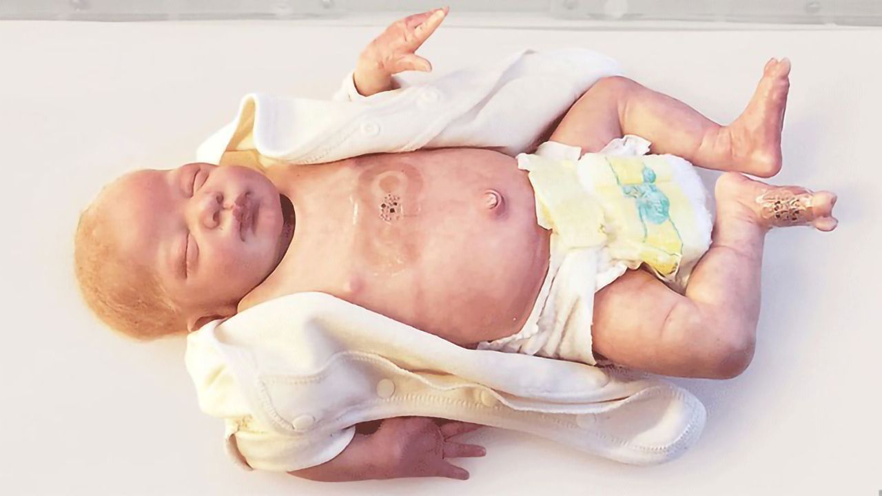 Wireless Sensors for Neonates Remove the Cuddle-barrier Tangle