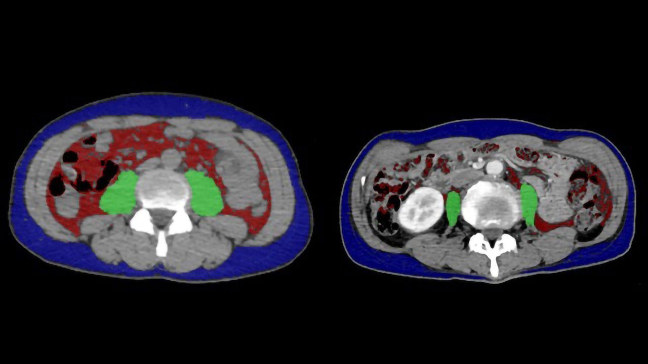 Muscle Mass Status Indicative of Cancer Therapy Response
