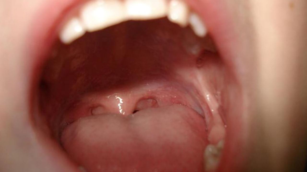 Taking the Sting Out of Mouth Ulcers