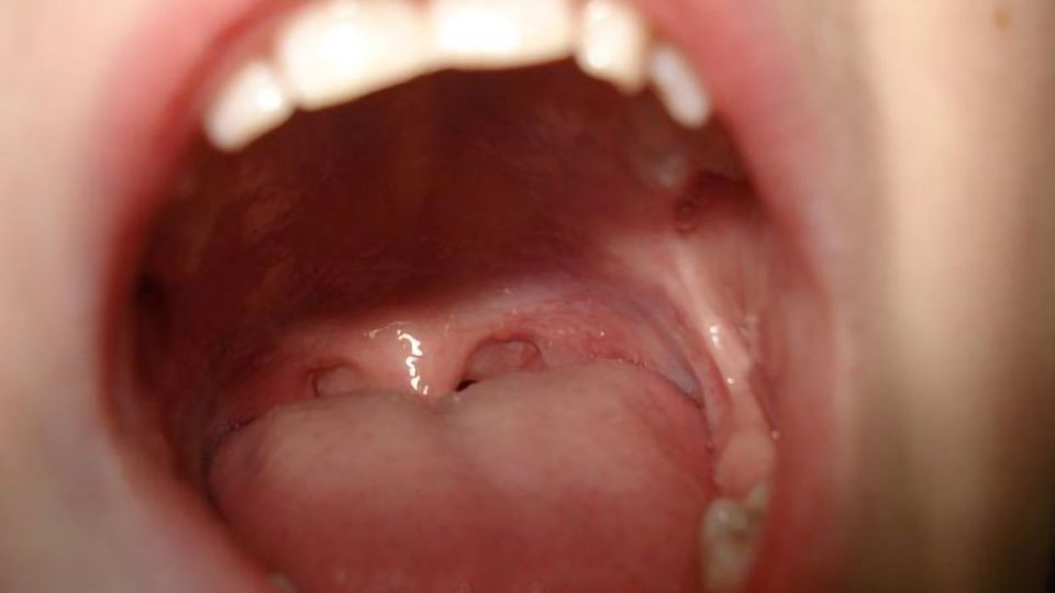 Taking the Sting Out of Mouth Ulcers content piece image