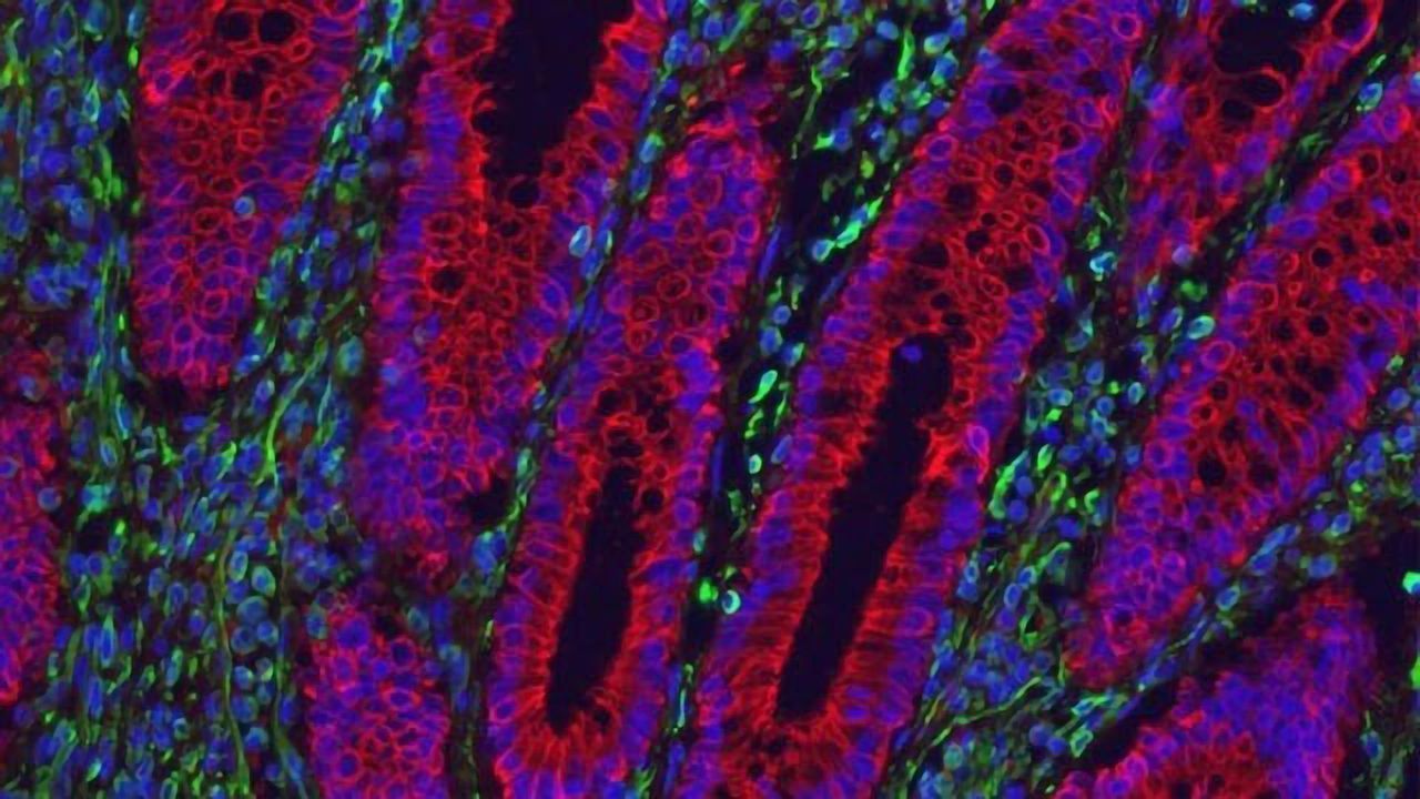 Potential New Therapy for Crohn’s and Colitis Discovered