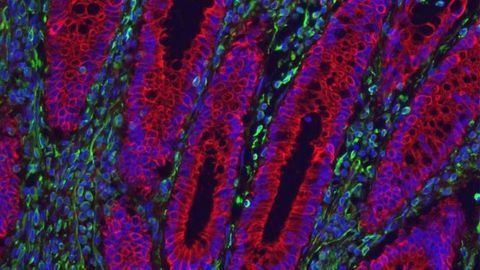 Potential New Therapy for Crohn’s and Colitis Discovered