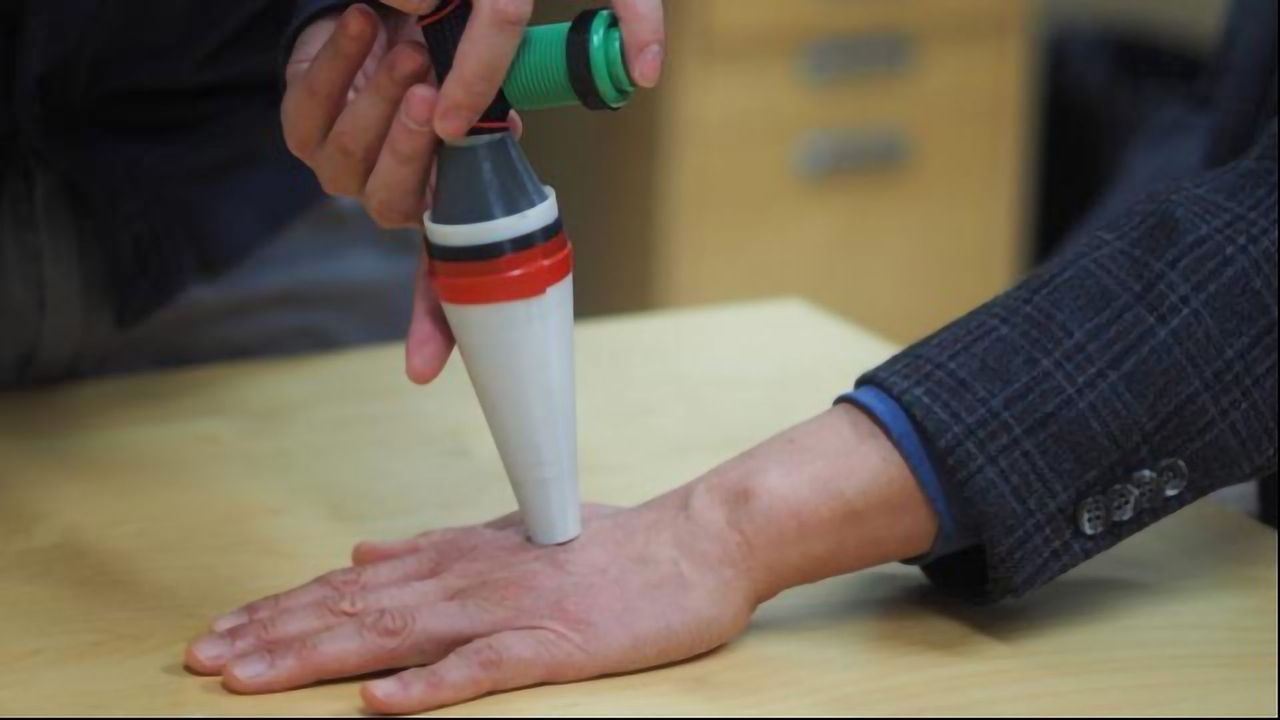 “Cancer Probe” Could Detect Deadly Melanoma Early