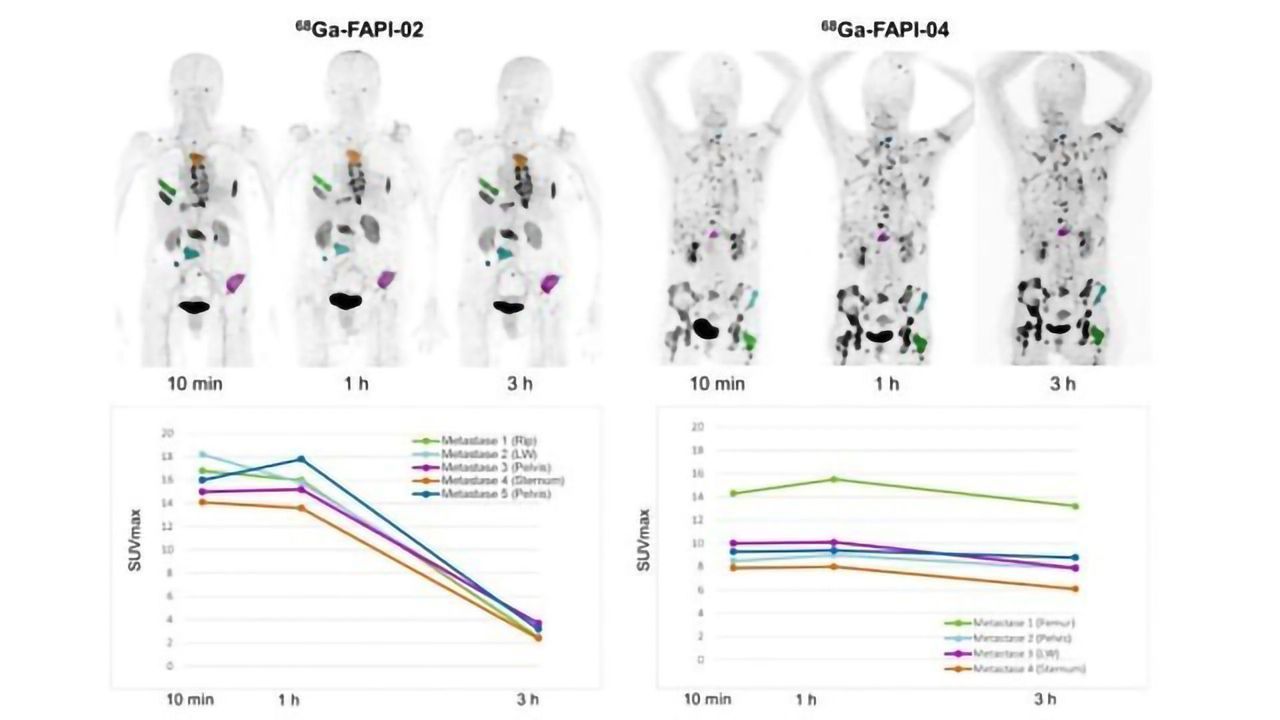 Two New Tracers Improve Diagnosis of Cancer
