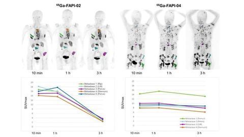 Two New Tracers Improve Diagnosis of Cancer