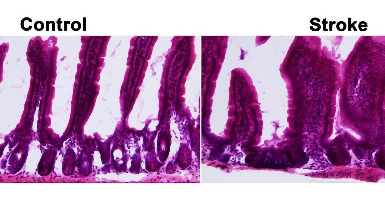 How Is the Microbiome Affected by Stroke?