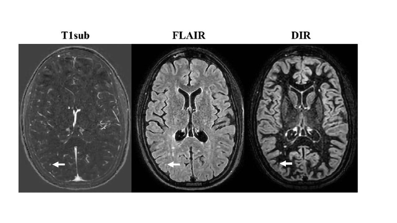 Non-contrast MRI Proves Effective in Monitoring MS Patients