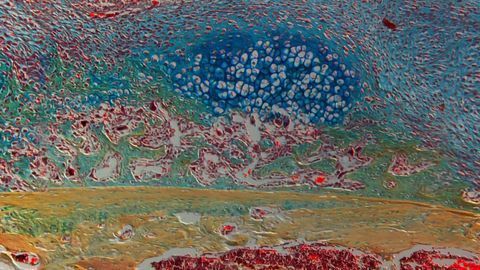 "Inflamm-aging" Results in Loss of Bone-healing Ability in the Elderly