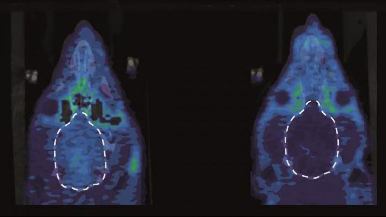Blunting Pain’s Emotional Component