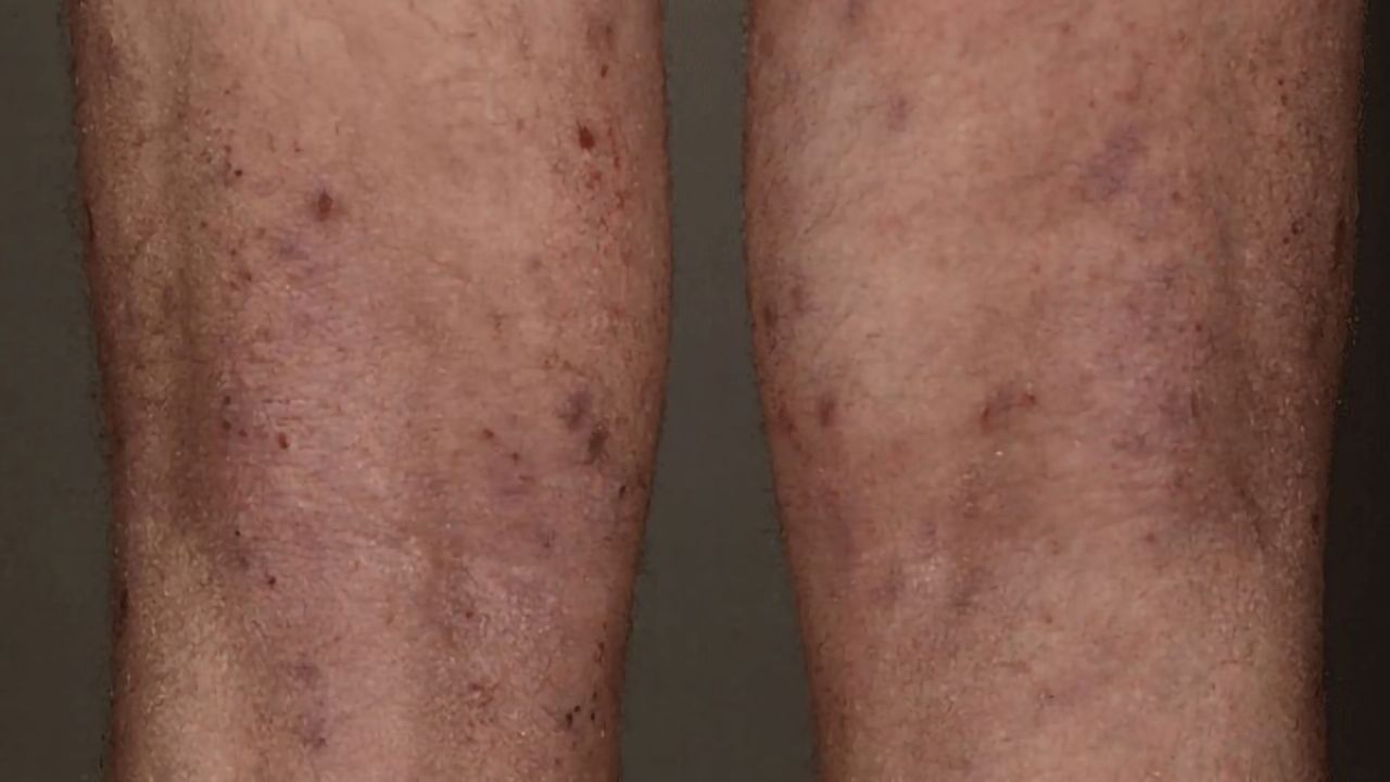 Response to Skin Fungi Pivotal in Dermatitis Pathway