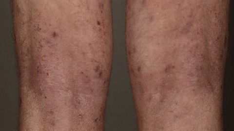 Response to Skin Fungi Pivotal in Dermatitis Pathway