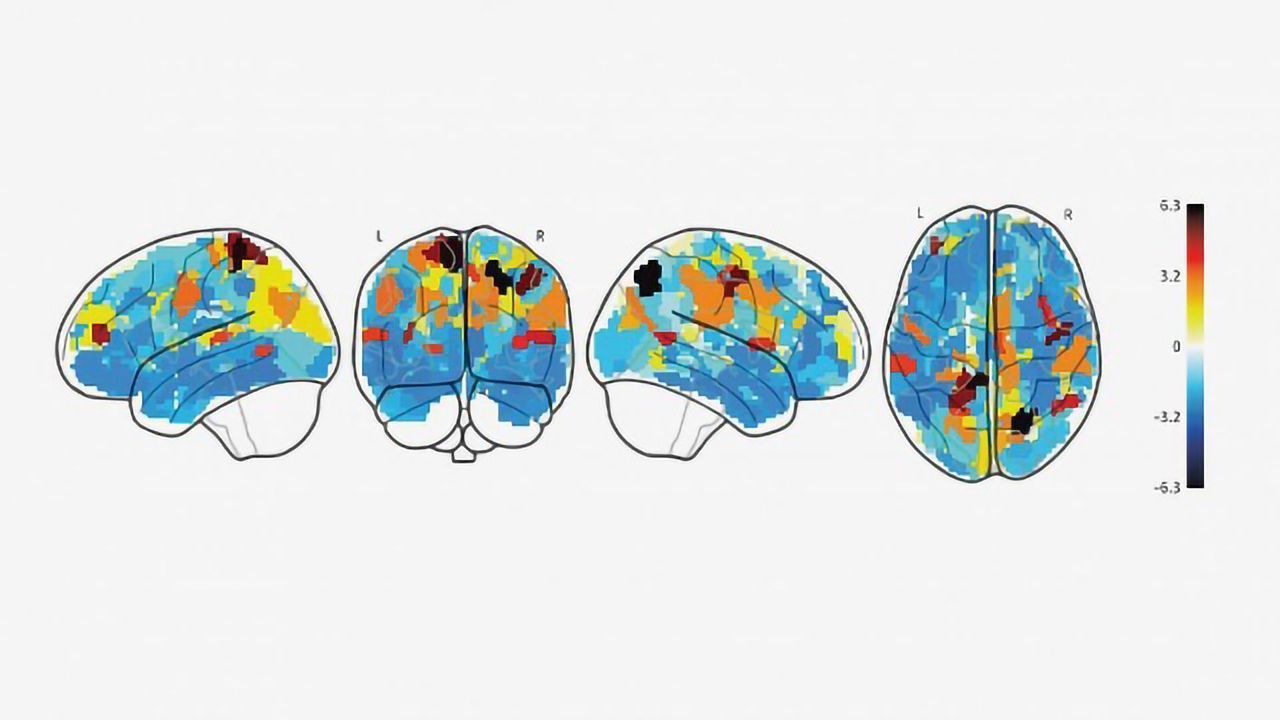 How the Brain is Different in Anhedonia