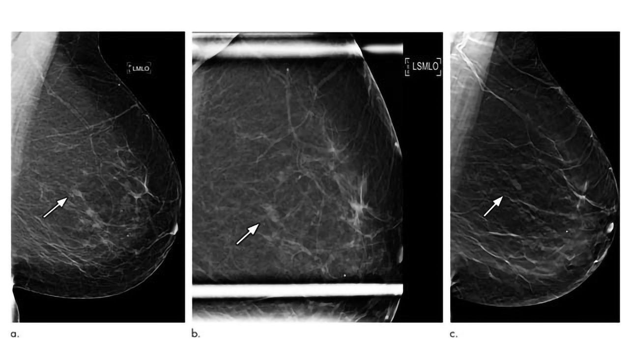 3D Mammography Significantly Reduces Breast Biopsy Rates