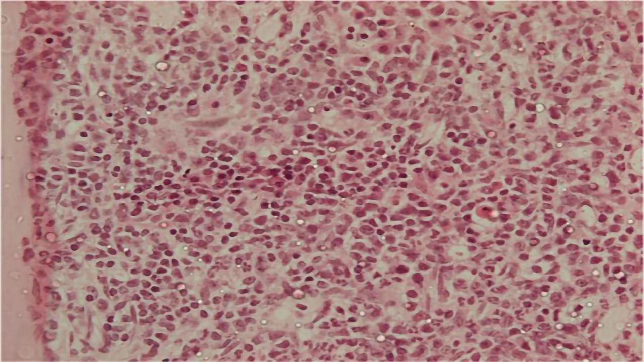 Protein Switches Sides in Leukemia