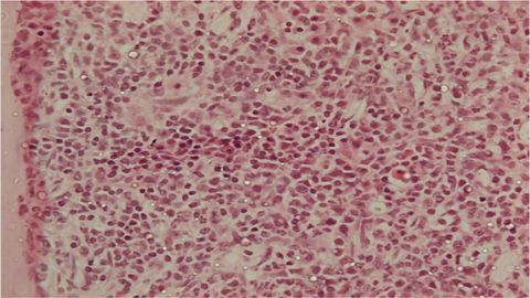 Protein Switches Sides in Leukemia